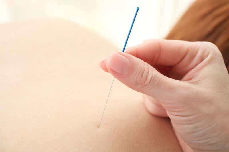 Acupuncture