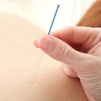 brisbane acupuncture: carina heights