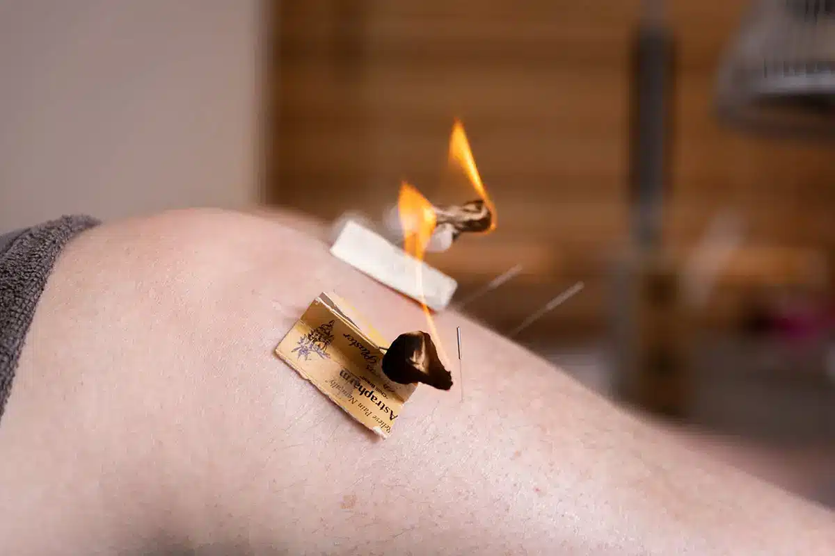 moxibustion stick: knee moxibustion: moxa moxibustion on patients back