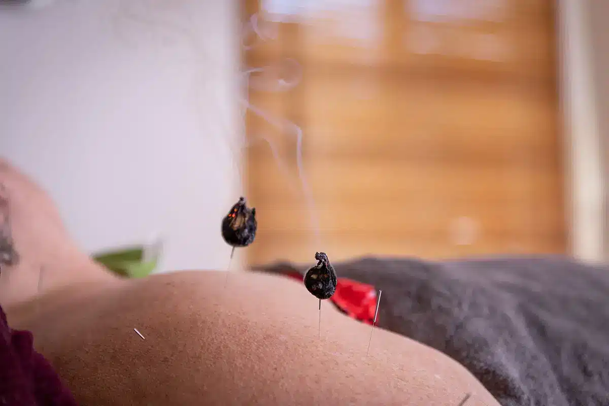 moxa stick: shoulder moxibustion: moxa moxibustion on patients back